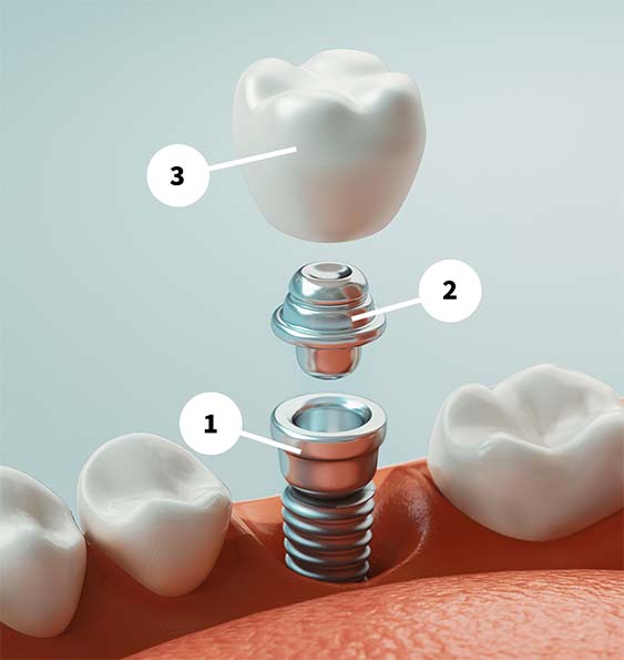 implants-diagram